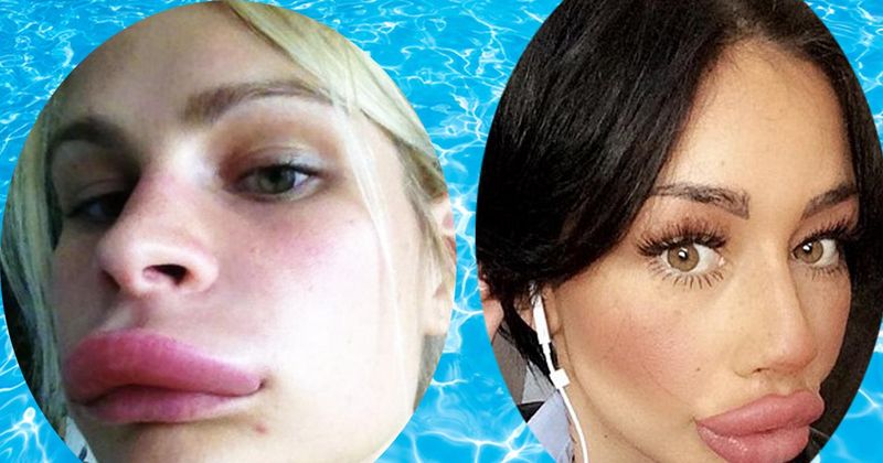 18 mensen met opblaasbare lippen: dé zwembad trend van 2019